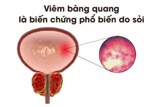 nguyen-nhan-gay-soi-bang-quang-1.jpg