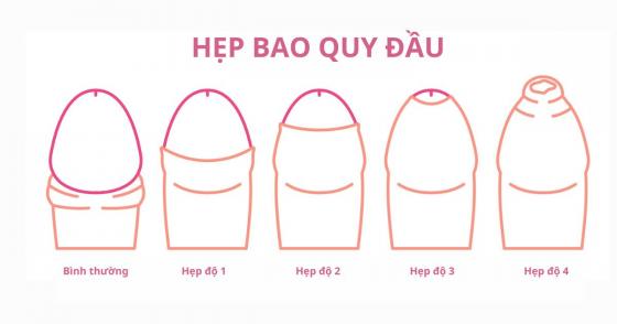 bao-quy-dau-bi-hep-co-sao-khong-1.jpg