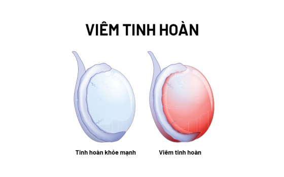 viem-tinh-hoan-kieng-gi.png
